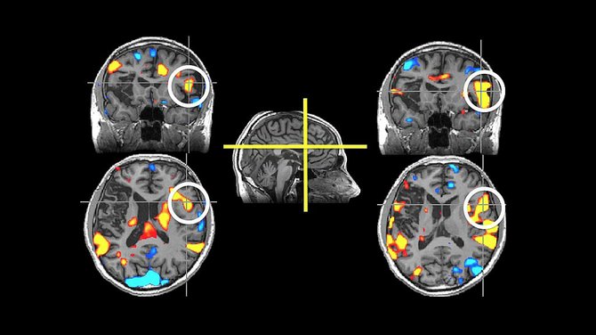 Strokes, or “brain attacks” can permanantly—and fatally—affect parts of the brain, as seen in these scans.