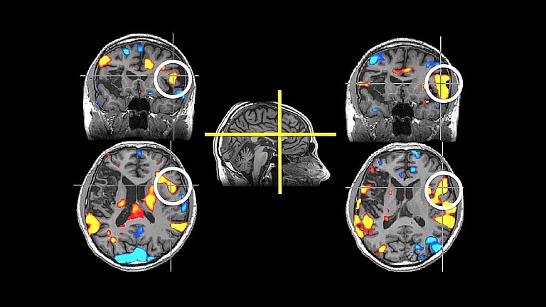 Strokes, or “brain attacks” can permanantly—and fatally—affect parts of the brain, as seen in these scans.